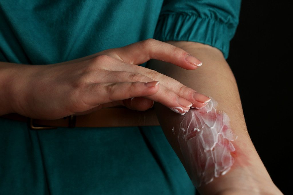 burn injury lawyer PA